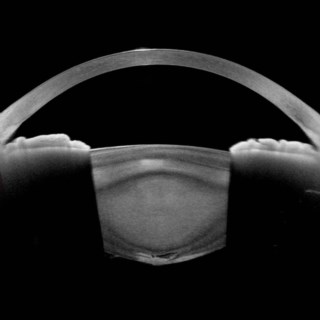 This image shows Posterior Polar Cataract, which is a clinically and surgically unique subtype of congenital cataract.
.
Image Courtesy: Dr. Prasanna Ramesh,
Mahatma Eye Hospital, 
Trichy.