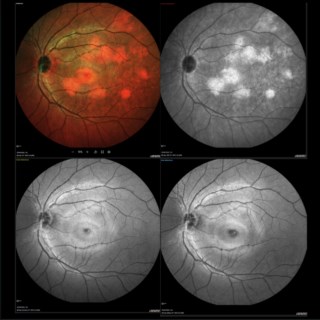 Multicolour and infrared images of a 36-year-old woman’s left eye show hyper-reflective patches in the posterior pole. Green/blue reflectance, fundus exam, and OCT are normal.
Impression: Ghost maculopathy
Dr. Ashok Nataraj
