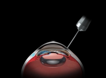 Optional glaucoma Solution