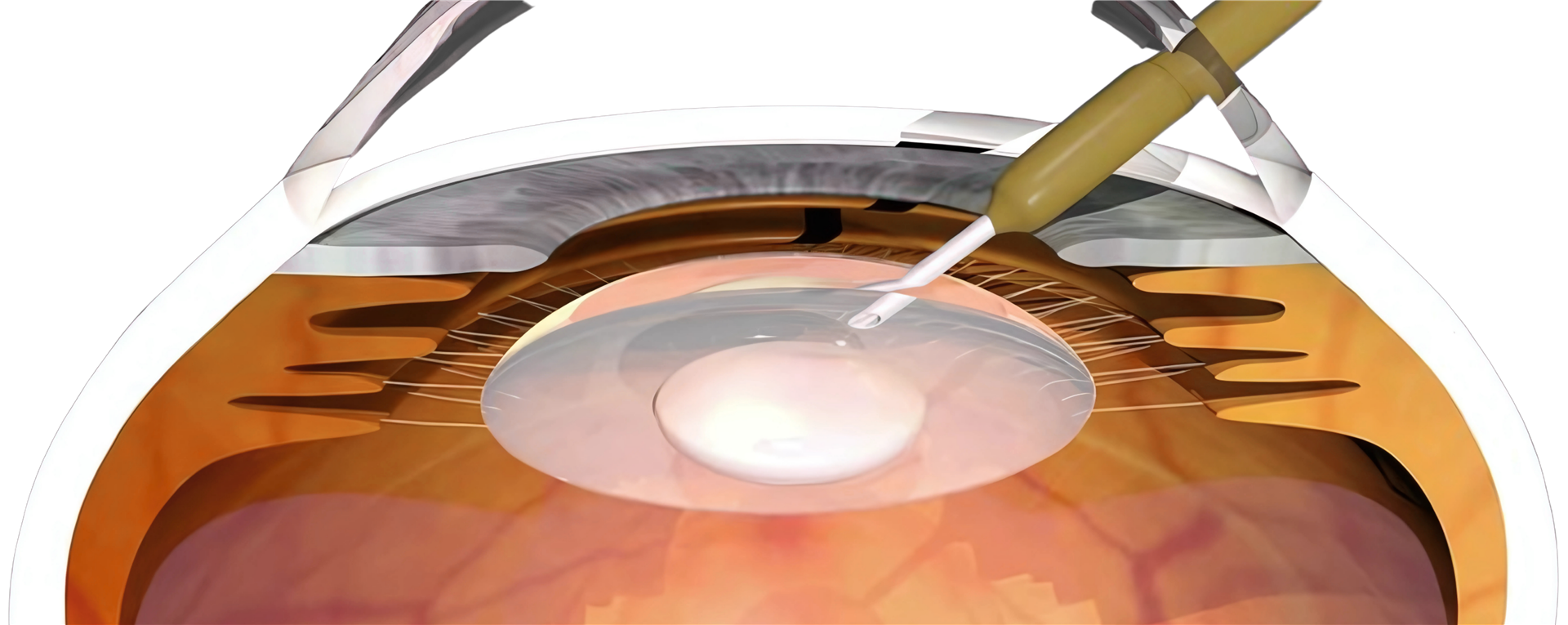 Phacoemulsification & Vitrectomy Systems